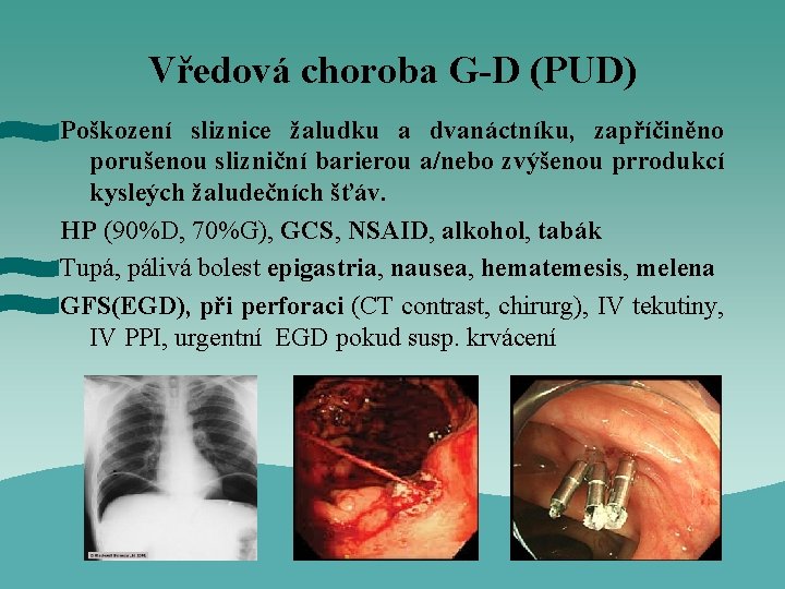 Vředová choroba G-D (PUD) Poškození sliznice žaludku a dvanáctníku, zapříčiněno porušenou slizniční barierou a/nebo