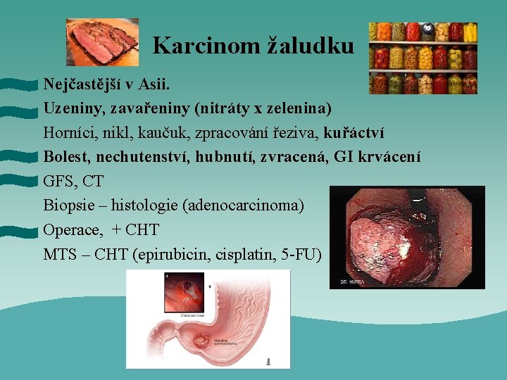 Karcinom žaludku Nejčastější v Asii. Uzeniny, zavařeniny (nitráty x zelenina) Horníci, nikl, kaučuk, zpracování