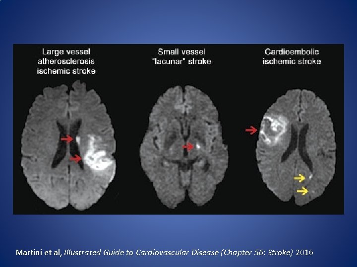 Martini et al, Illustrated Guide to Cardiovascular Disease (Chapter 56: Stroke) 2016 