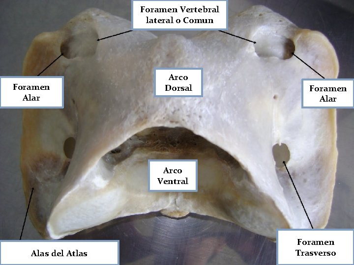 Foramen Vertebral lateral o Comun Foramen Alar Arco Dorsal Foramen Alar Arco Ventral Alas