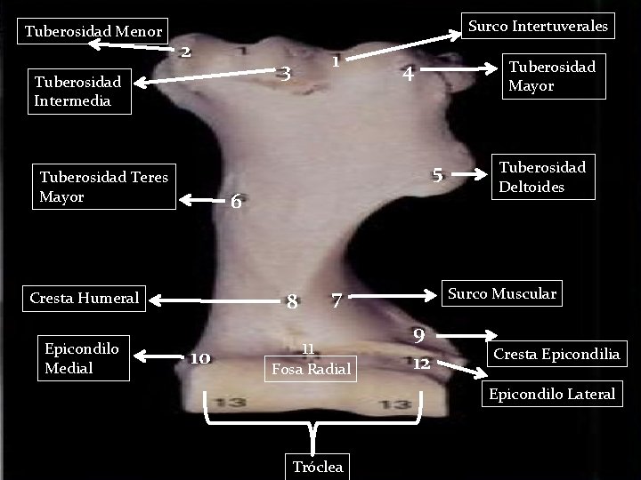 Tuberosidad Menor Surco Intertuverales 2 Tuberosidad Intermedia 4 Tuberosidad Mayor 5 Tuberosidad Teres Mayor