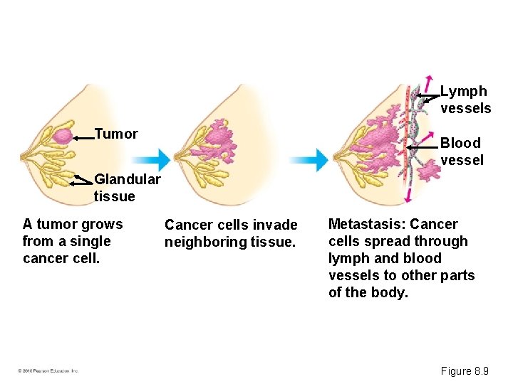 Lymph vessels Tumor Blood vessel Glandular tissue A tumor grows from a single cancer