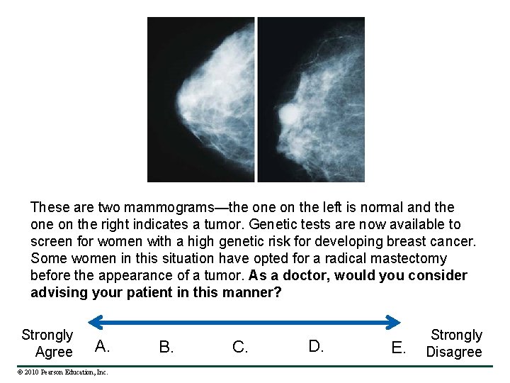 These are two mammograms—the on the left is normal and the on the right