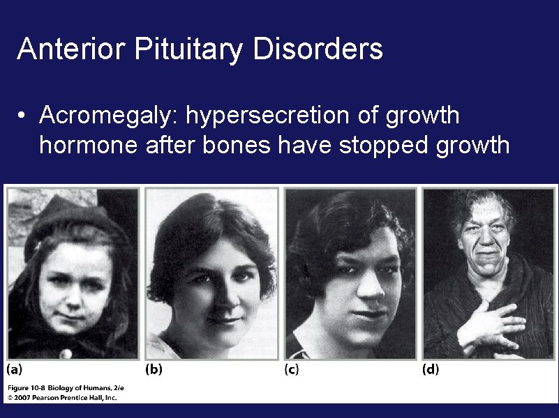 Anterior Pituitary Disorders • Acromegaly: hypersecretion of growth hormone after bones have stopped growth
