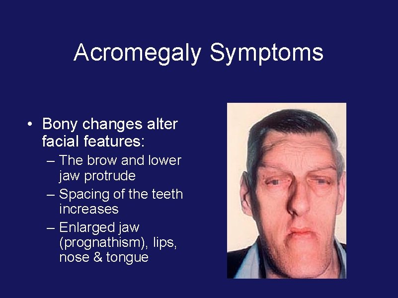 Acromegaly Symptoms • Bony changes alter facial features: – The brow and lower jaw