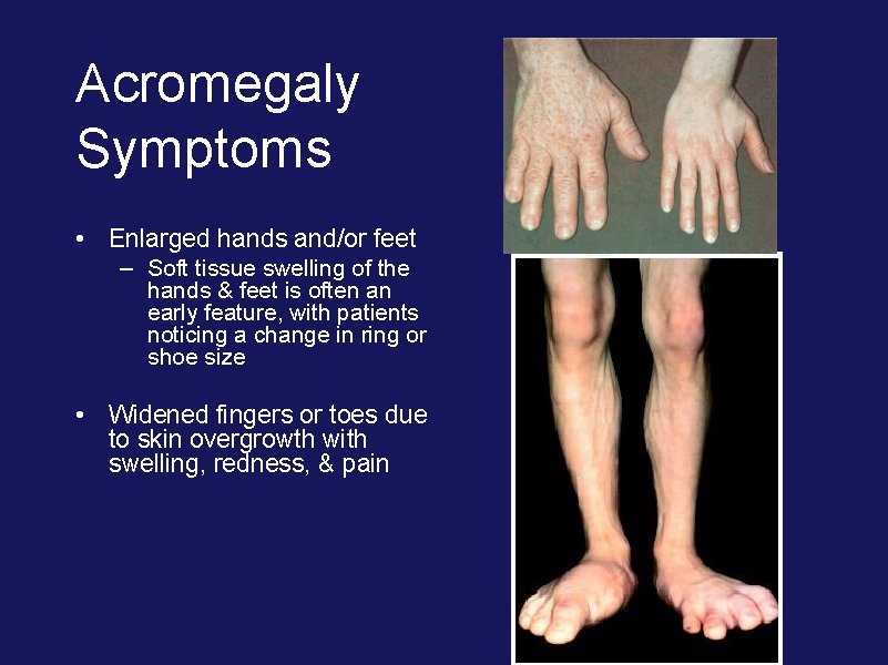 Acromegaly Symptoms • Enlarged hands and/or feet – Soft tissue swelling of the hands