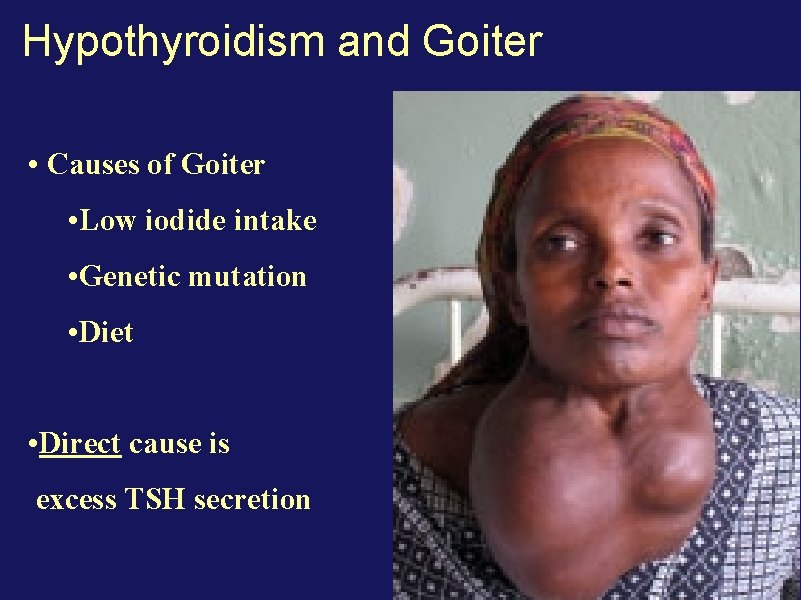 Hypothyroidism and Goiter • Causes of Goiter • Low iodide intake • Genetic mutation