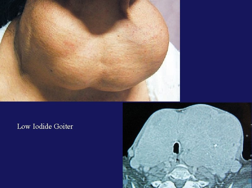 Low Iodide Goiter 