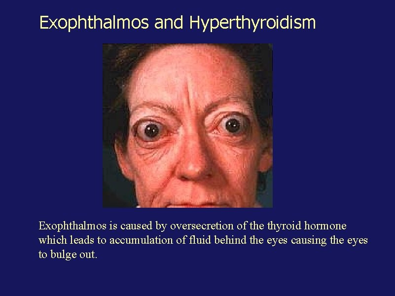 Exophthalmos and Hyperthyroidism Exophthalmos is caused by oversecretion of the thyroid hormone which leads