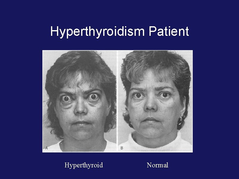 Hyperthyroidism Patient Hyperthyroid Normal 