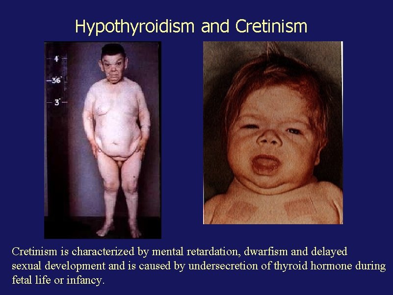 Hypothyroidism and Cretinism is characterized by mental retardation, dwarfism and delayed sexual development and