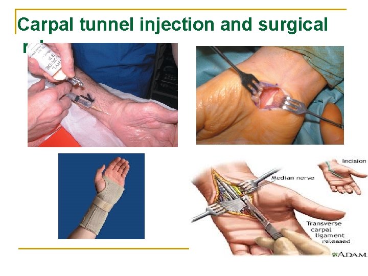 Carpal tunnel injection and surgical release 