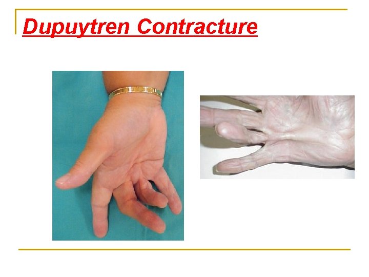 Dupuytren Contracture 