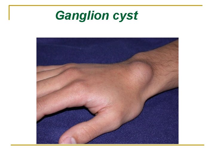 Ganglion cyst 