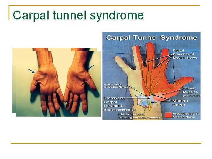 Carpal tunnel syndrome 