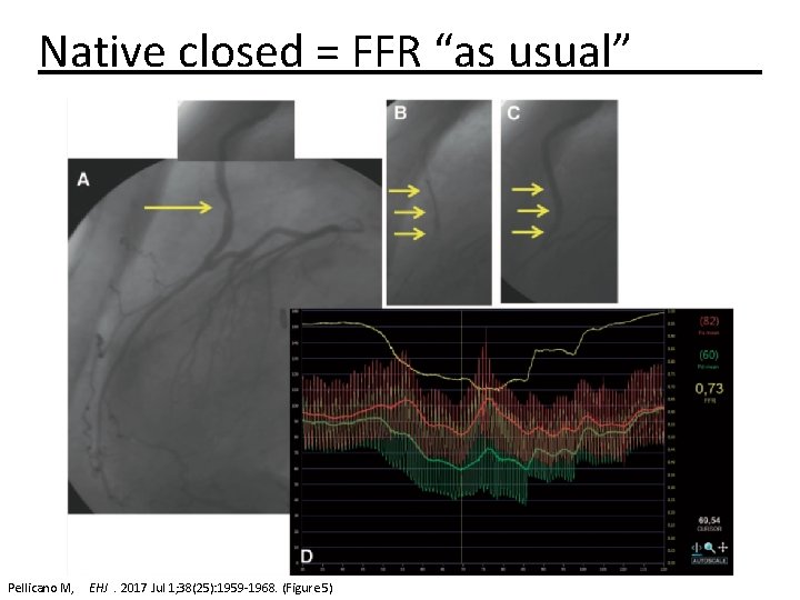 Native closed = FFR “as usual” Pellicano M, EHJ. 2017 Jul 1; 38(25): 1959