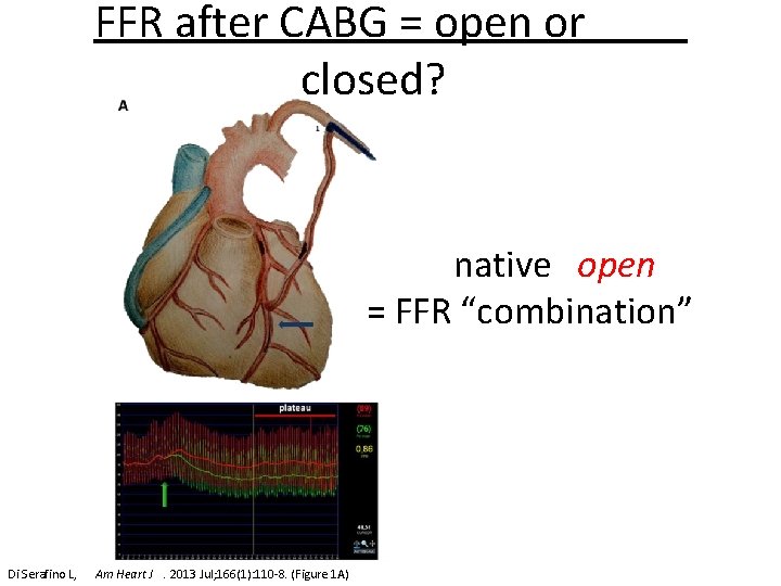 FFR after CABG = open or closed? native open = FFR “combination” Di Serafino