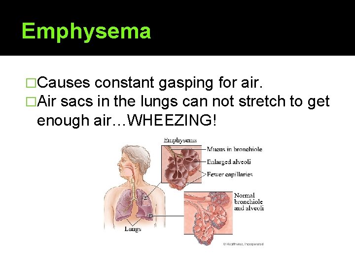 Emphysema �Causes constant gasping for air. �Air sacs in the lungs can not stretch