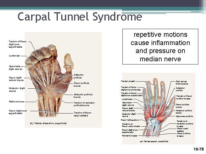 Carpal Tunnel Syndrome repetitive motions cause inflammation and pressure on median nerve Tendon of