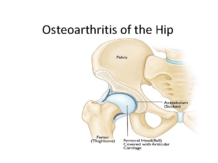 Osteoarthritis of the Hip 