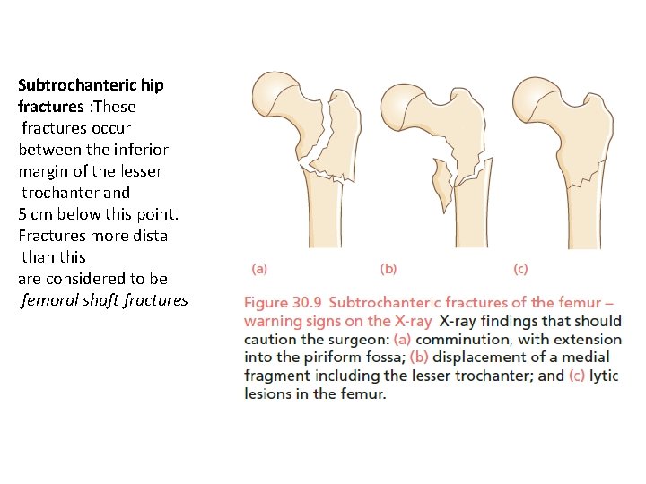 Subtrochanteric hip fractures : These fractures occur between the inferior margin of the lesser