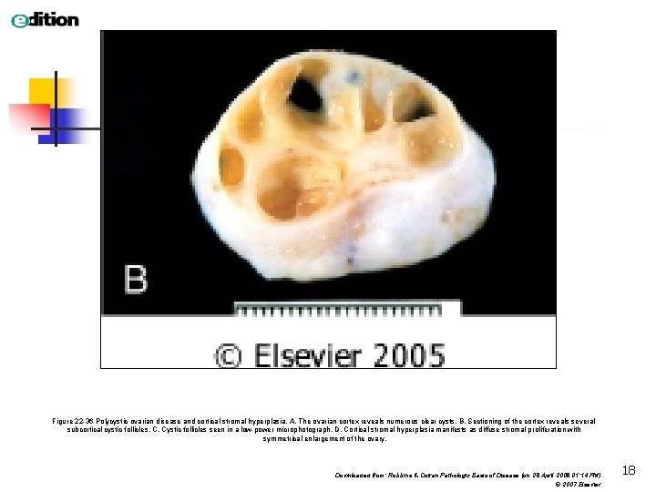 Figure 22 -36 Polycystic ovarian disease and cortical stromal hyperplasia. A, The ovarian cortex