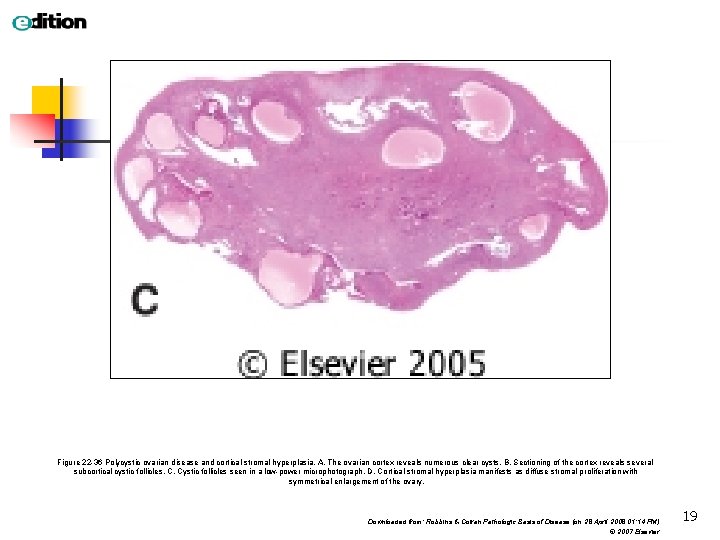 Figure 22 -36 Polycystic ovarian disease and cortical stromal hyperplasia. A, The ovarian cortex