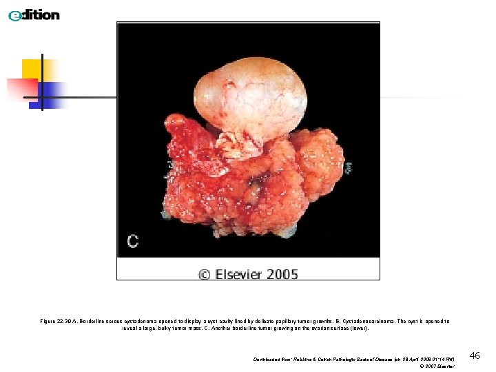 Figure 22 -39 A, Borderline serous cystadenoma opened to display a cyst cavity lined