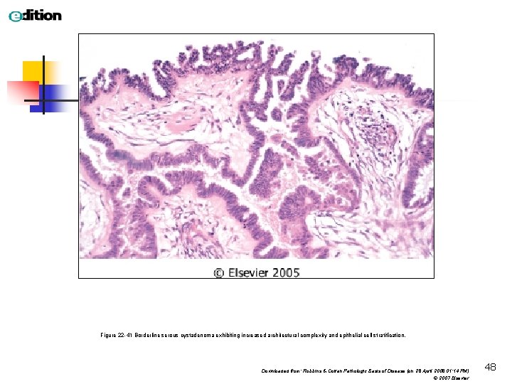 Figure 22 -41 Borderline serous cystadenoma exhibiting increased architectural complexity and epithelial cell stratification.