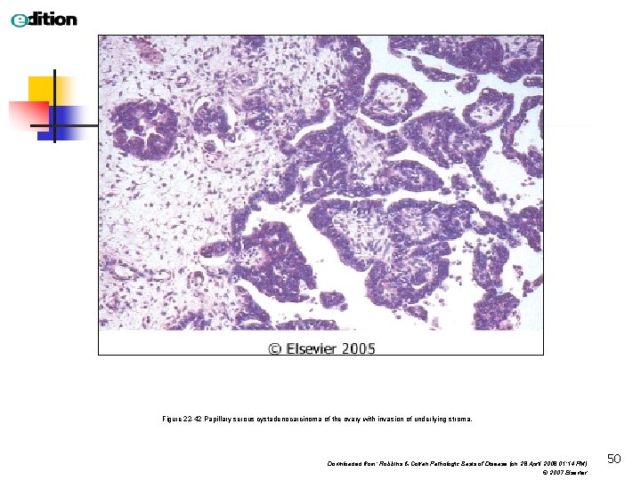 Figure 22 -42 Papillary serous cystadenocarcinoma of the ovary with invasion of underlying stroma.