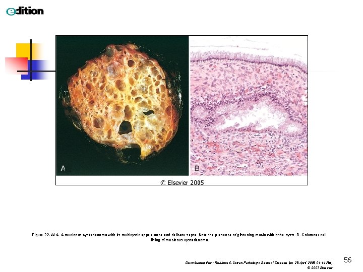 Figure 22 -44 A, A mucinous cystadenoma with its multicystic appearance and delicate septa.