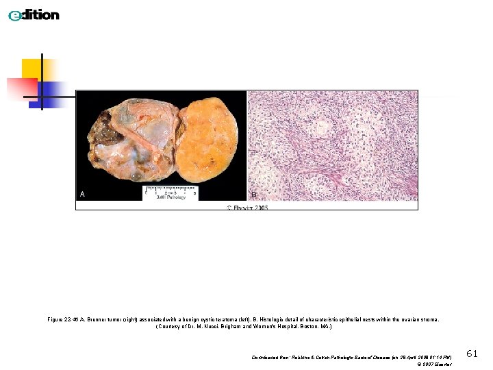 Figure 22 -46 A, Brenner tumor (right) associated with a benign cystic teratoma (left).