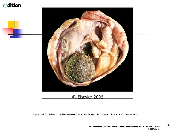 Figure 22 -48 Opened mature cystic teratoma (dermoid cyst) of the ovary. Hair (bottom)