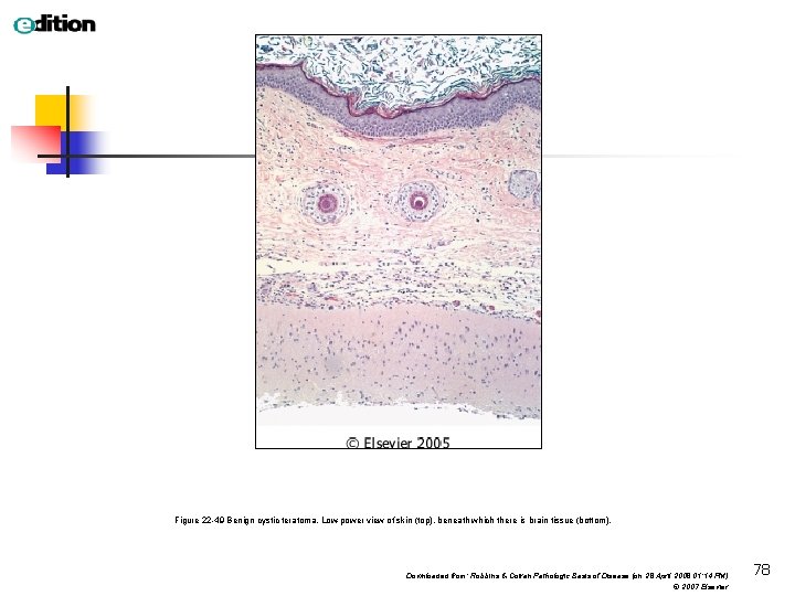Figure 22 -49 Benign cystic teratoma. Low-power view of skin (top), beneath which there
