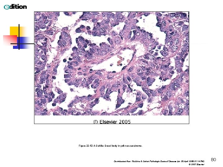Figure 22 -52 A Schiller-Duval body in yolk sac carcinoma. Downloaded from: Robbins &