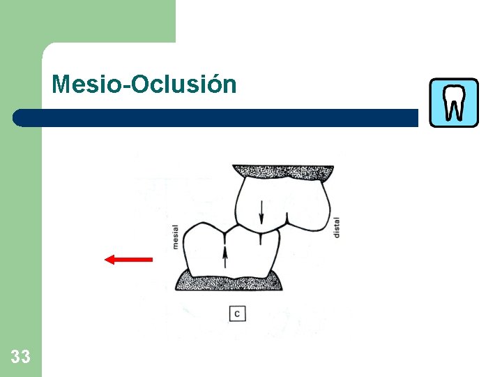 Mesio-Oclusión 33 