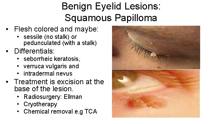 Benign Eyelid Lesions: Squamous Papilloma • Flesh colored and maybe: • sessile (no stalk)