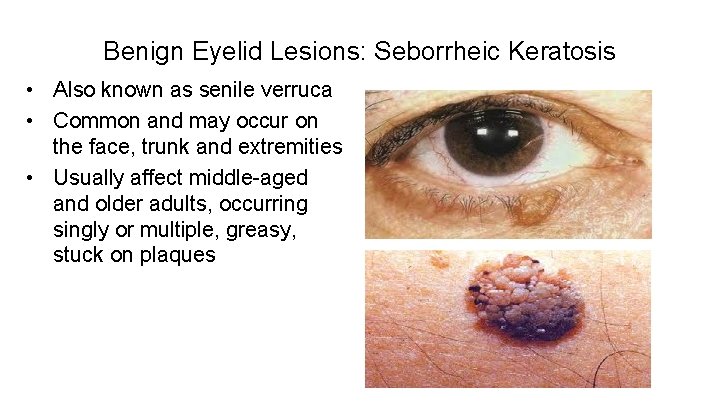 Benign Eyelid Lesions: Seborrheic Keratosis • Also known as senile verruca • Common and