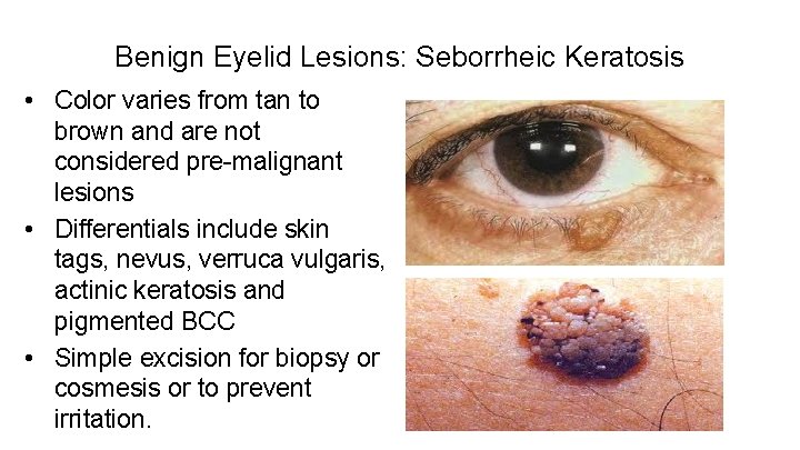 Benign Eyelid Lesions: Seborrheic Keratosis • Color varies from tan to brown and are