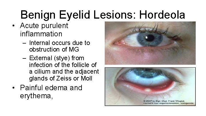 Benign Eyelid Lesions: Hordeola • Acute purulent inflammation – Internal occurs due to obstruction