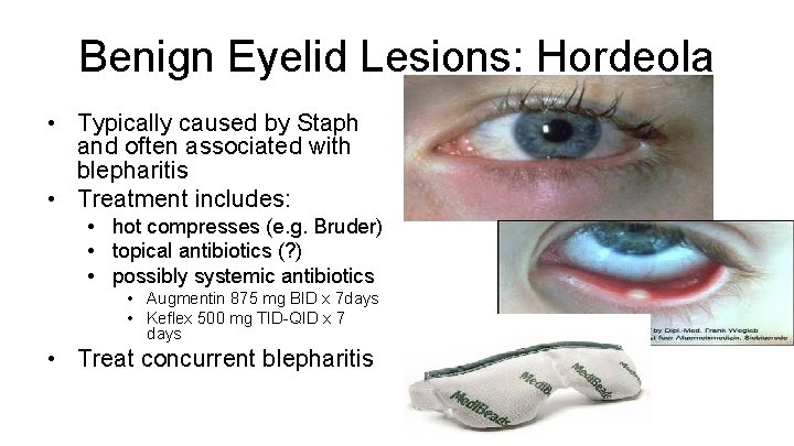 Benign Eyelid Lesions: Hordeola • Typically caused by Staph and often associated with blepharitis