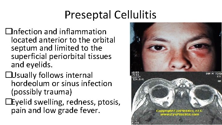Preseptal Cellulitis �Infection and inflammation located anterior to the orbital septum and limited to