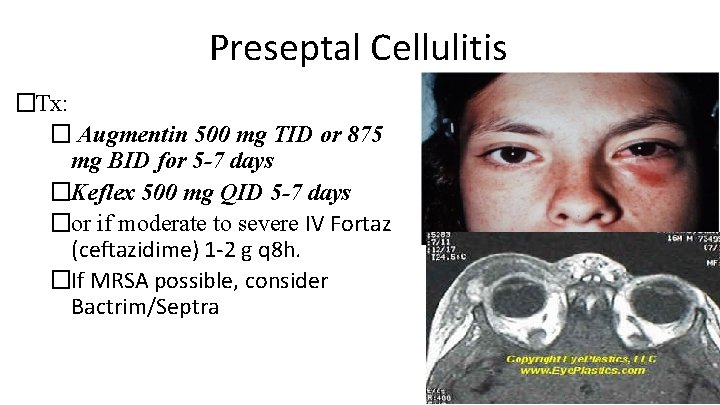 Preseptal Cellulitis �Tx: � Augmentin 500 mg TID or 875 mg BID for 5