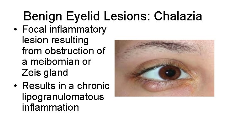 Benign Eyelid Lesions: Chalazia • Focal inflammatory lesion resulting from obstruction of a meibomian