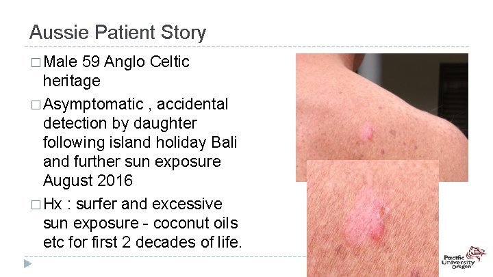 Aussie Patient Story � Male 59 Anglo Celtic heritage � Asymptomatic , accidental detection