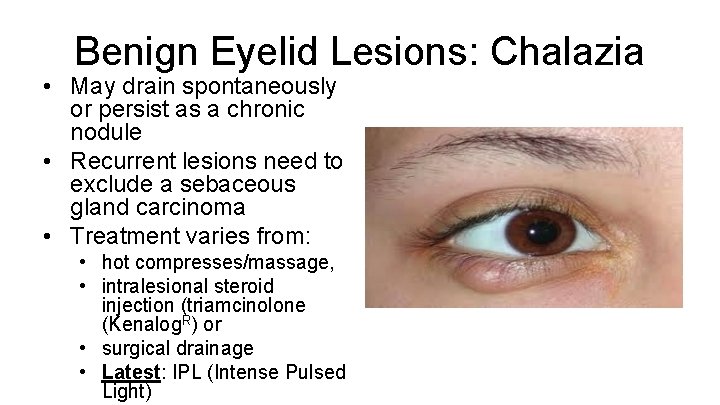 Benign Eyelid Lesions: Chalazia • May drain spontaneously or persist as a chronic nodule
