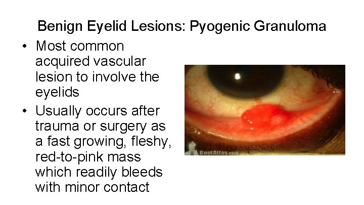 Benign Eyelid Lesions: Pyogenic Granuloma • Most common acquired vascular lesion to involve the