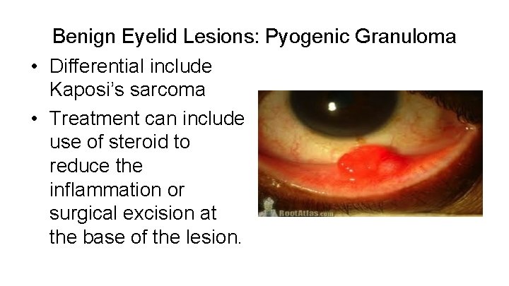 Benign Eyelid Lesions: Pyogenic Granuloma • Differential include Kaposi’s sarcoma • Treatment can include