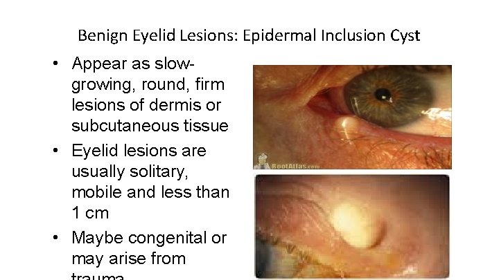 Benign Eyelid Lesions: Epidermal Inclusion Cyst • Appear as slowgrowing, round, firm lesions of