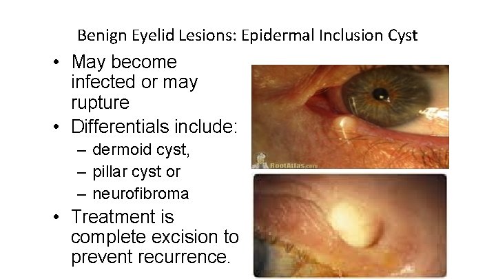 Benign Eyelid Lesions: Epidermal Inclusion Cyst • May become infected or may rupture •